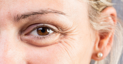 Falten unter den Augen