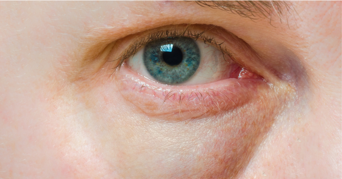 Geschwollene Augen