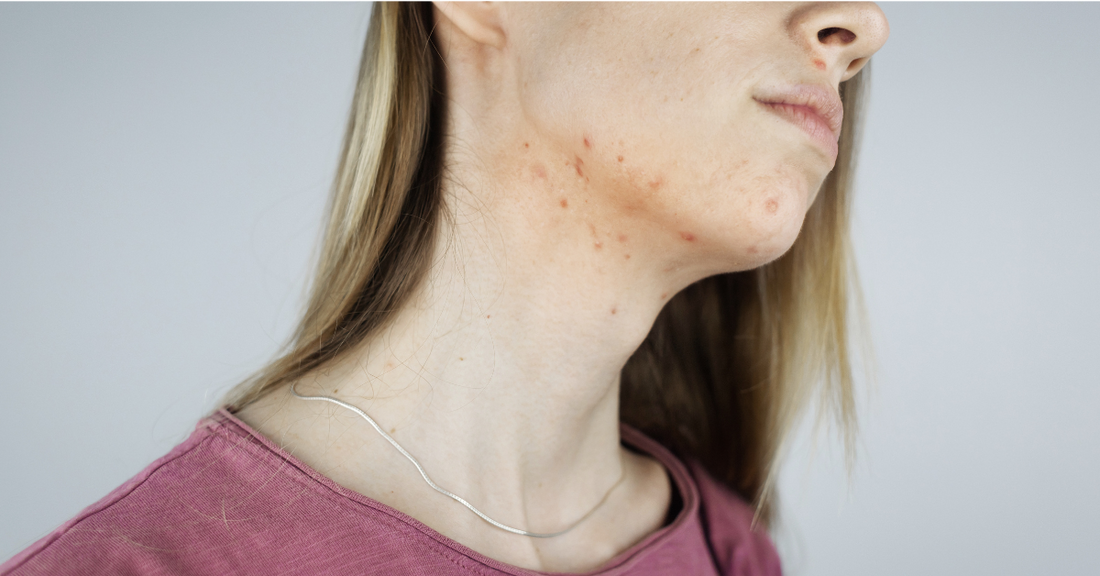 Pickeln am Hals