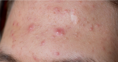 Pickeln auf der Stirn