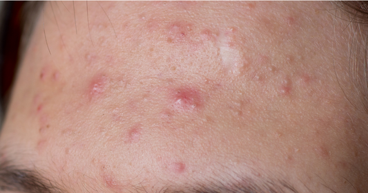 Pickeln auf der Stirn