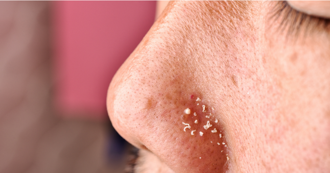  Sebaceous Filaments